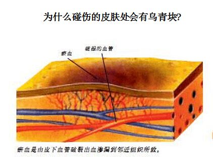 為什么碰傷的皮膚處會有烏青塊