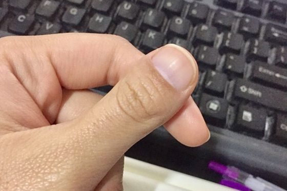 人的大拇指為什么只有兩節(jié),拇指怎么只有兩個關(guān)節(jié)