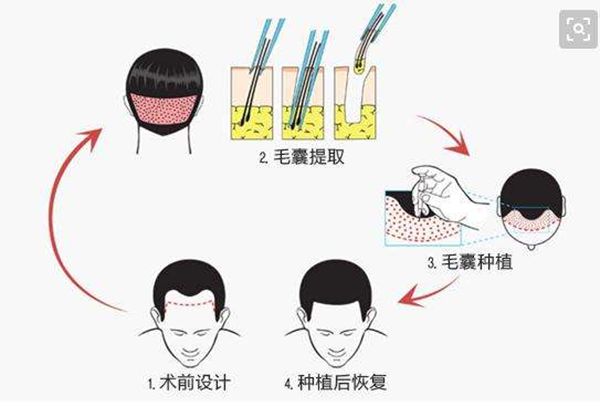 發際線為什么會后移,發際線后移該怎么辦